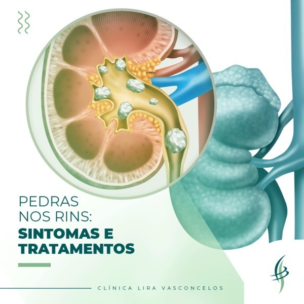 Pedra nos rins: Sintomas e Tratamentos – Clínica Lira Vasconcelos